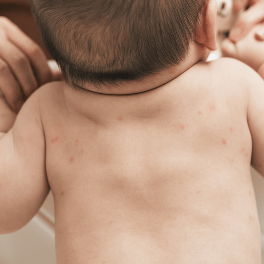 Why Fragrance-Free Matters for Sensitive & Eczema-Prone Skin - Scrachee