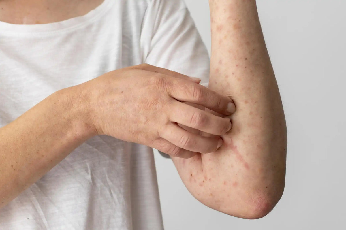 ¿Puede desaparecer el eczema?