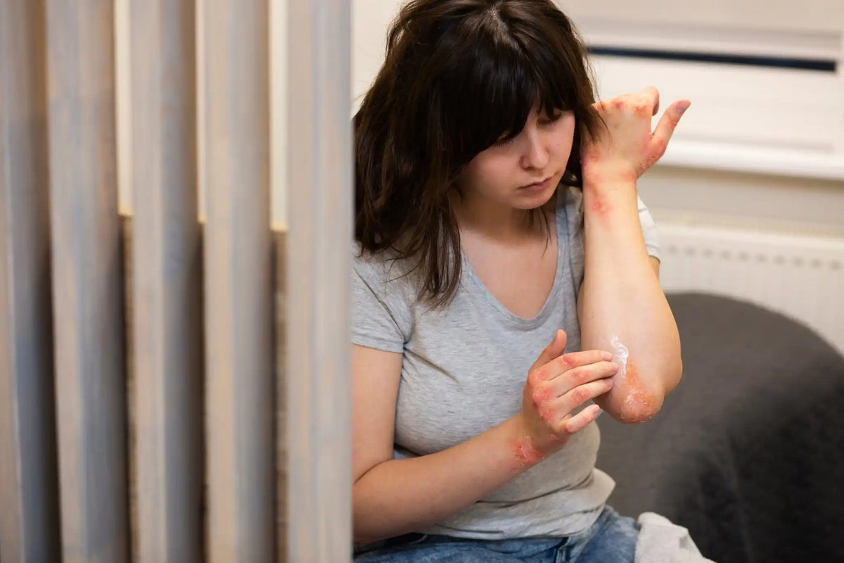 ¿Pueden los adultos desarrollar dermatitis atópica?