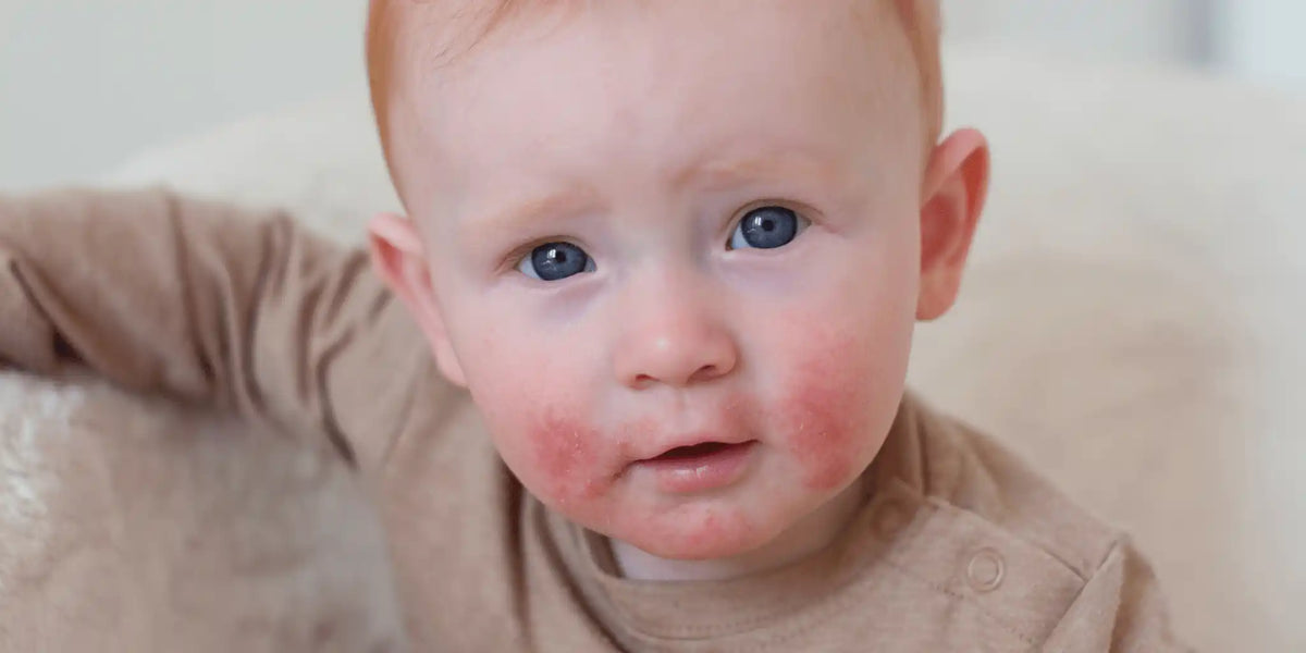 Identificando los 7 tipos de eczema: una guía visual