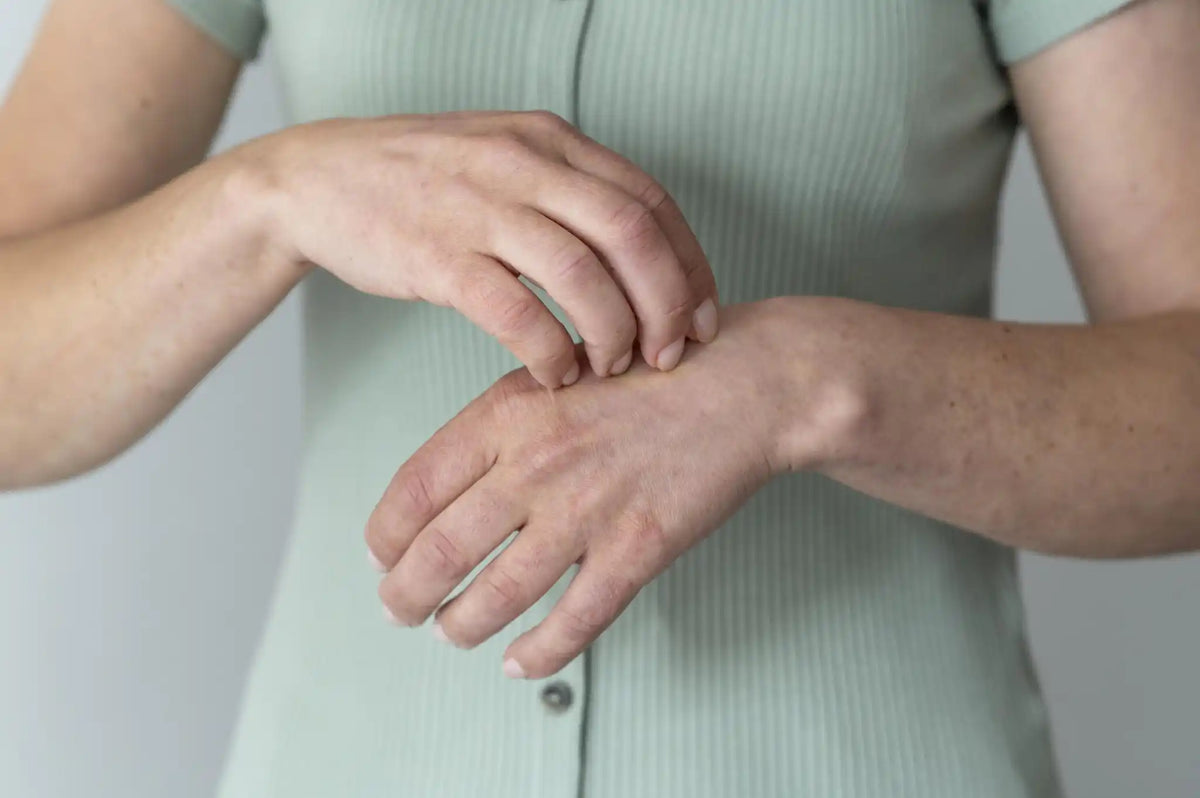 Cómo manejar el eczema dishidrótico: cómo aliviar los síntomas